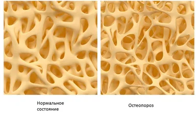 Остеопороза | Симптомы | Сеть Клиник «ЗдравКлиник»