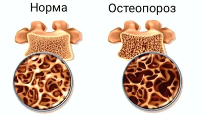 Лечение остеопороза в Екатеринбурге - Новая Больница