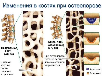 Алтайские медики рассказали, кто чаще всего болеет остеопорозом и можно ли  предотвратить заболевание