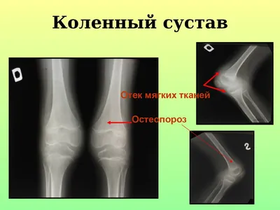 Изображения остеопороза кистей рук: скачайте и используйте в своих работах