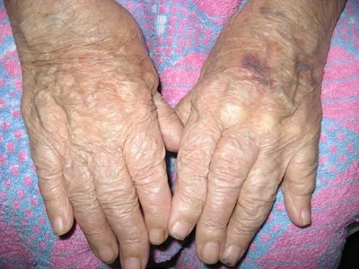 Остеопороз кистей рук: фото для обучения и практики в медицине