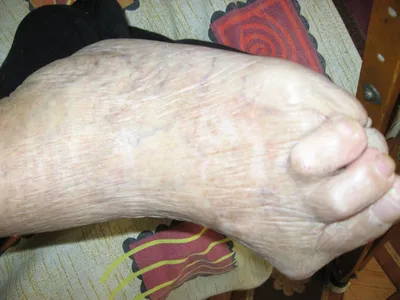 Остеопороз кистей рук: фото для пациентов и врачей