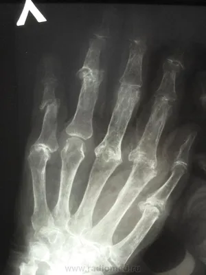 Фото остеопороза кистей рук: скачайте в формате JPG, PNG, WebP