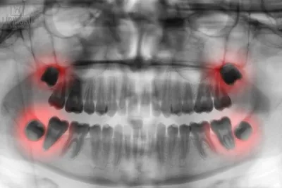 Отек после удаления зуба мудрости: как облегчить состояние пациента