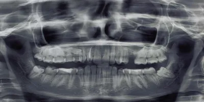 Фотография отека после удаления зуба мудрости: как ускорить процесс заживления