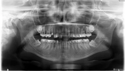 После удаления зуба мудрости: фото отека и как справиться с болью