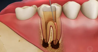 Фото зуба с открытым каналом: как это выглядит?