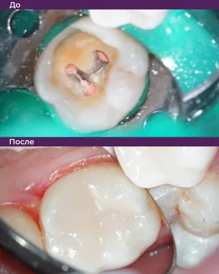 Изображение открытого канала зуба: причины и лечение