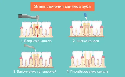 Фотография открытого канала зуба: что такое этот процесс?