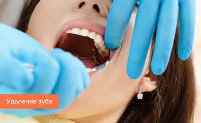 Фотография зуба с открытым каналом: какие лечебные меры применяются?