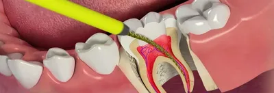 Картинка открытого канала зуба: какие причины могут привести к этому?