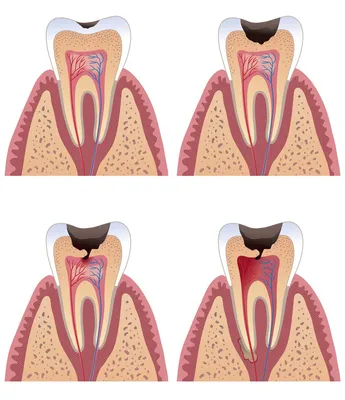 Фото открытого канала зуба: какие симптомы свидетельствуют о проблеме?