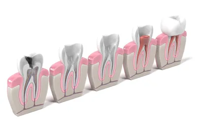 Изображение открытого канала зуба: как восстановить зуб после лечения?