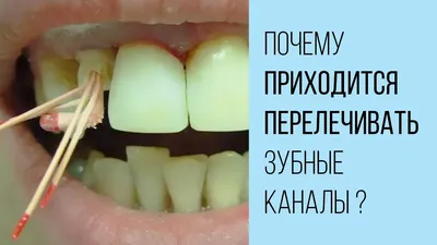 Фото зуба с открытым каналом: какие риски возникают при отсутствии лечения?