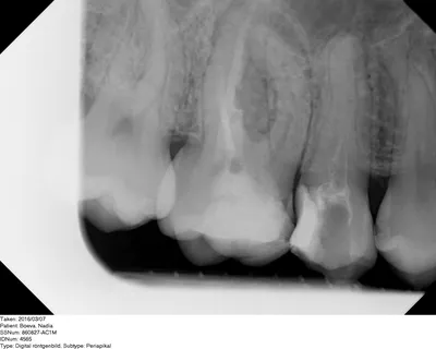 Изображение открытого канала зуба: какие меры предосторожности помогут сохранить здоровье зубов?