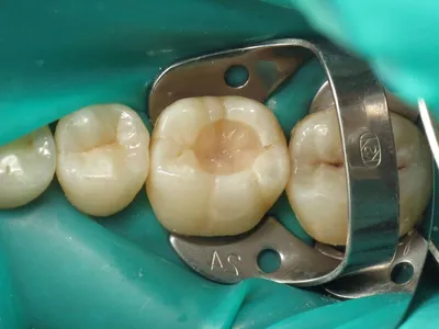 Картинка Открытый Канал Зуба: важность здоровых зубов