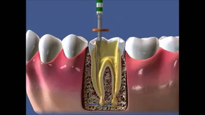 Открытый канал зуба на фото: как не допустить осложнений?