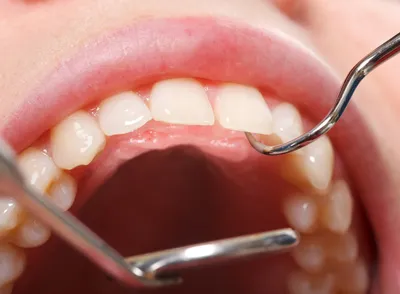 Картинка Открытый Канал Зуба: как избежать кариеса и других заболеваний зубов