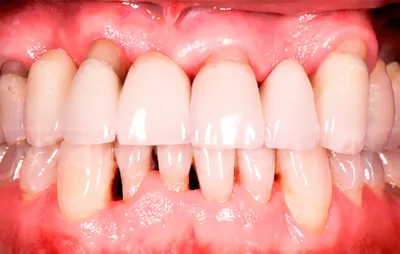 Изображение Открытый Канал Зуба: как избежать проблем со здоровьем полости рта
