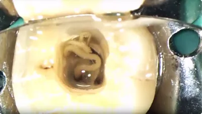 Фотография зуба с открытым каналом: как происходит лечение?