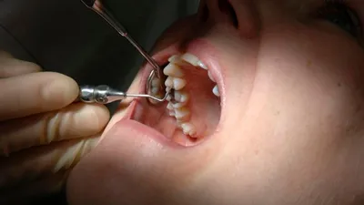 Изображение открытого канала зуба: какие последствия могут быть?