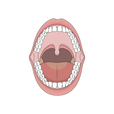 Открытый рот со сломанными больными зубами и Periodontitis костоедой  затрагиваемыми. Стальной штифт в десны для установки зубного Стоковое Фото  - изображение насчитывающей нерв, заболевание: 172179240