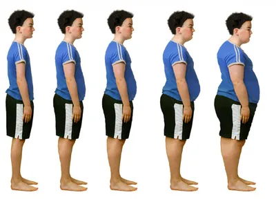 Ожирение: степени, типы, причины, диагностика и профилактика
