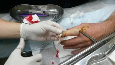 Панариций на руке: фото после хирургического вмешательства