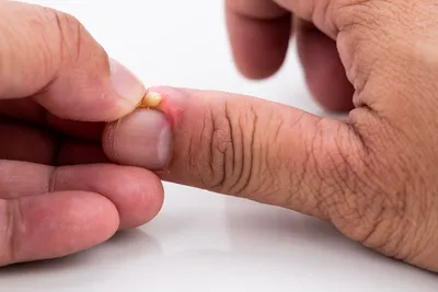 Фото панариция на руке: как уберечься от инфекции