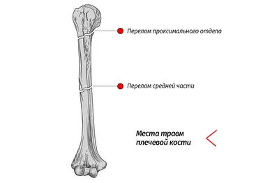 Изображение руки с парезом у повара