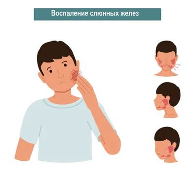 Симптомы и что нужно знать о свинке(эпидемический паротит) | kazbekovskiy.ru