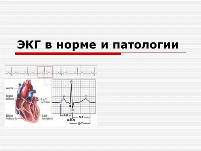 ЭКГ в норме и патологии - презентация онлайн