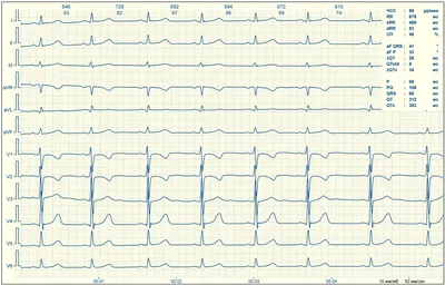 Зубец Т на ЭКГ - норма и патология - E-Cardio