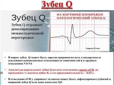 Электрокардиограмма. Норма ЭКГ - презентация онлайн