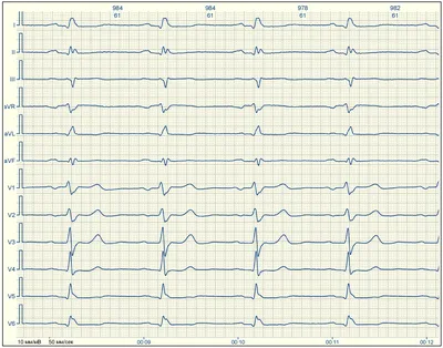 Расшифровка ЭКГ для чайников с примерами - E-Cardio