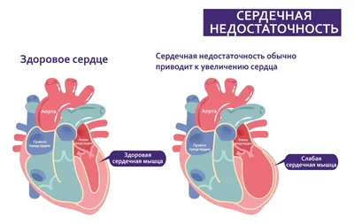 Сердечная недостаточность - симптомы, что это такое, как понять что она у  тебя, признаки