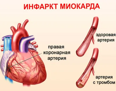 Запись ЭКГ после инфаркта миокарда