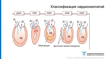 Инфаркт миокарда правого желудочка