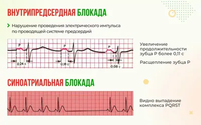 На ЭКГ блокада сердца: что это значит, простыми словами.