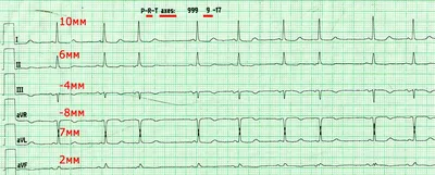 Патология экг в картинках фотографии