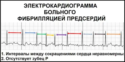 Изучение Экг краткий курс . | Схемы Кардиология | Docsity