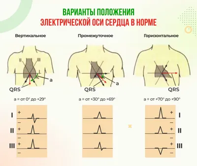 Фибрилляция предсердий (мерцательная аритмия)