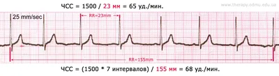 Всё, что нужно знать про ЭКГ | Медициниум | Дзен