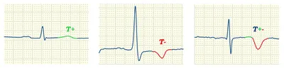 Зубец Т на ЭКГ - норма и патология - E-Cardio