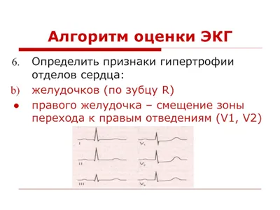 На ЭКГ блокада сердца: что это значит, простыми словами.