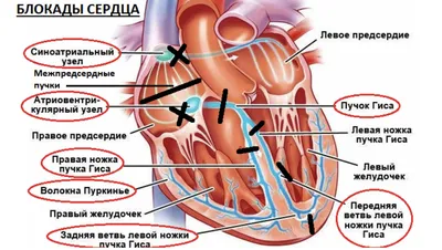 Блокады сердца – пугающее заключение на ЭКГ? | MEDICA MENTE | Блог о  медицине | Дзен