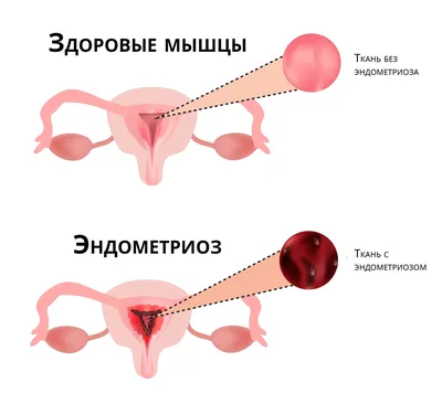 В общем, случайно наткнулся на данную статью и моя челюсть разлетелась  вдребезги об пол от прочитанн / просто в ахуе :: медицина :: неожиданно  хороший конец :: роды :: беременность :: болезнь ::