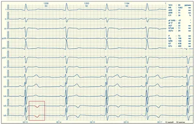 Зубец Т на ЭКГ - норма и патология - E-Cardio