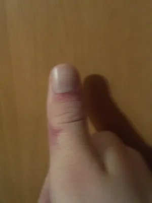 Фото перелома большого пальца в формате PNG