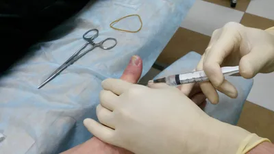 Картинка перелома большого пальца с массажем